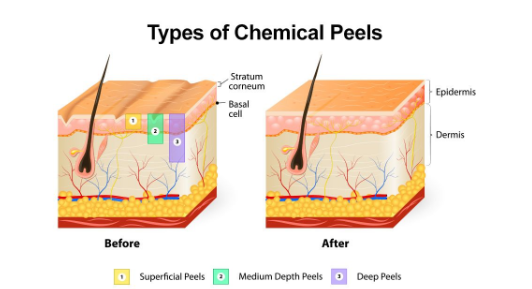 chemical peeling treatment