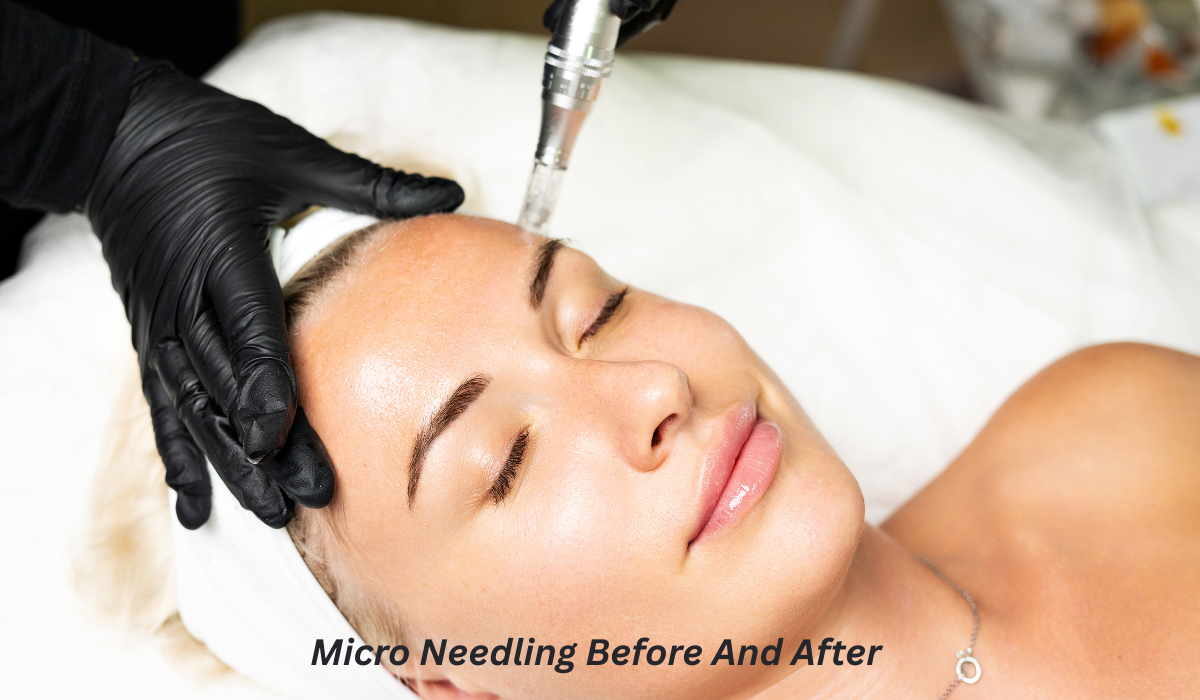 Micro Needling Before And After