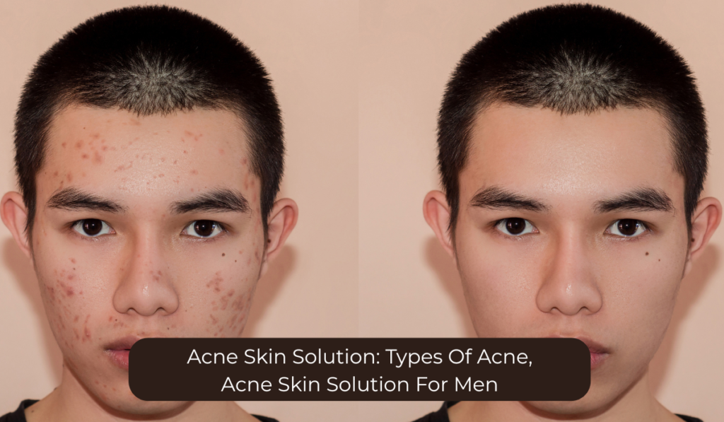 acne skin solution