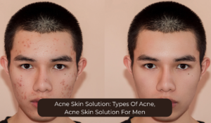acne skin solution