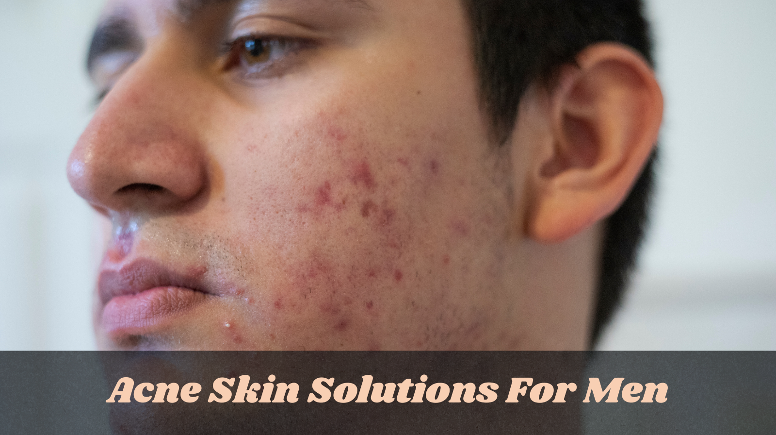 Acne Skin Solutions For Men