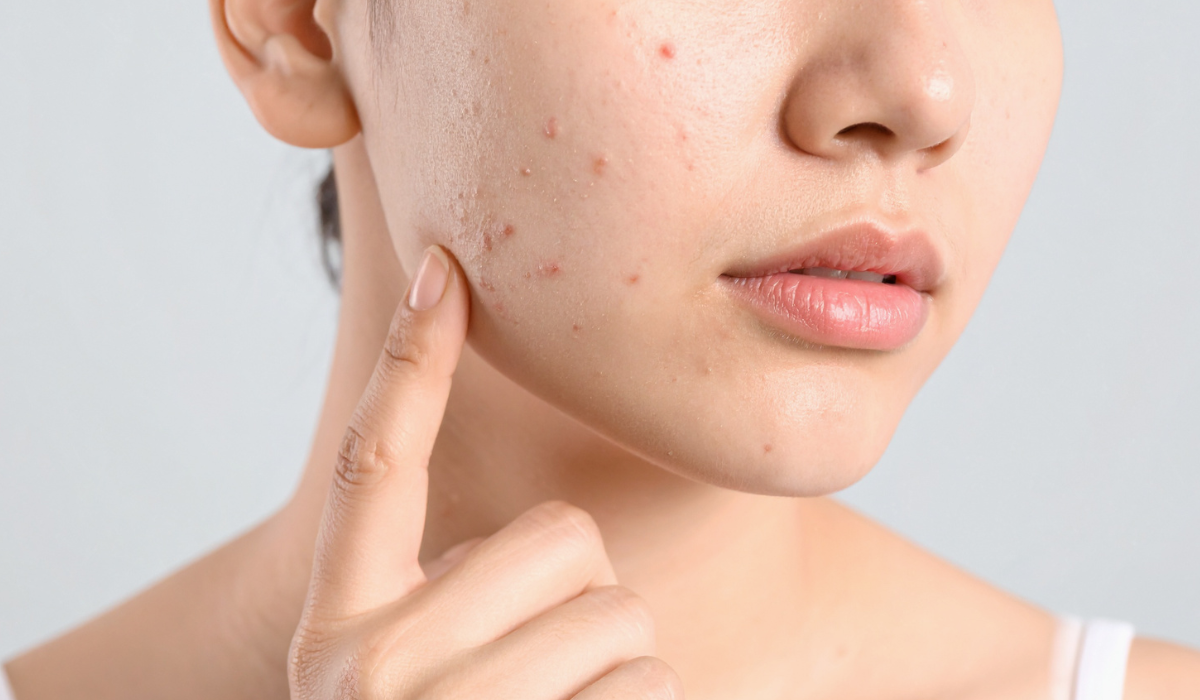 Pimple Skin Solution