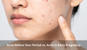 Acne Before Your Period vs. Acne in Early Pregnancy