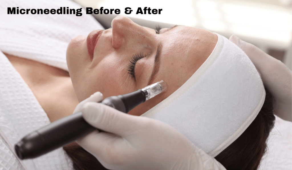 microneedling before and after